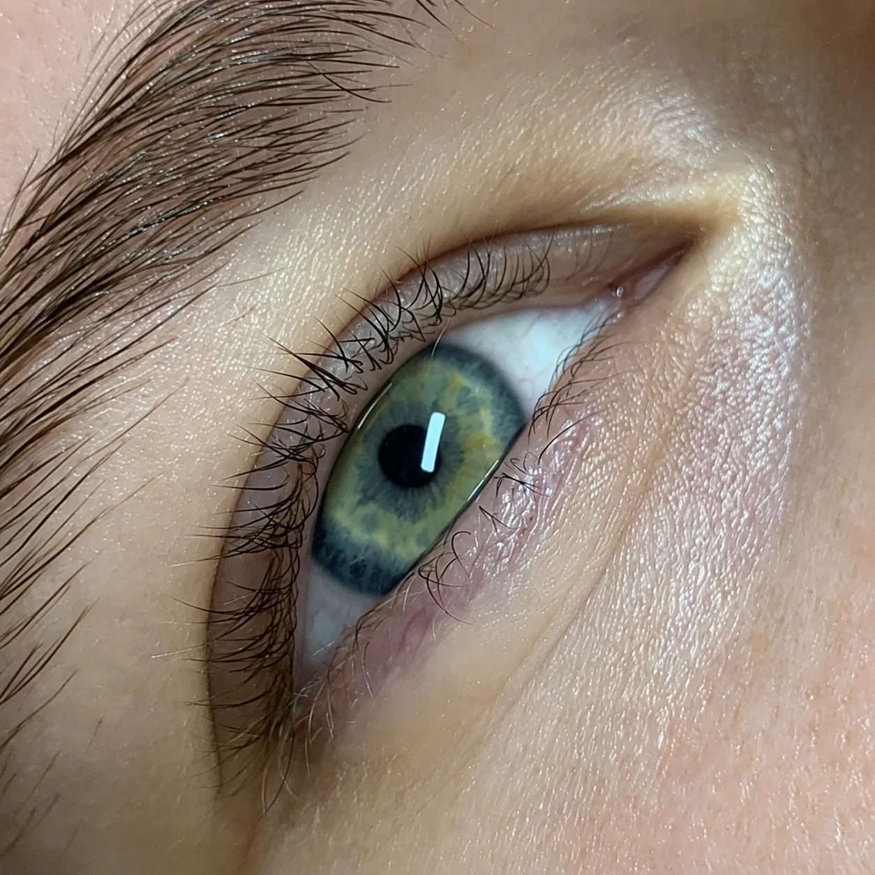 Dieselben Augen vor der Behandlung
